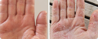 פסוריאזיס בידיים