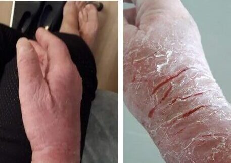 אסטמה של העור ביד - לפני ואחרי