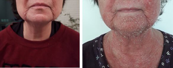 אטופיק דרמטיטיס חמור בפנים – לפני ואחרי 6 שבועות טיפול