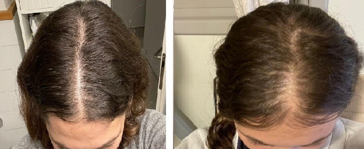 נשירת שיער נשים - לפני ואחרי טיפול