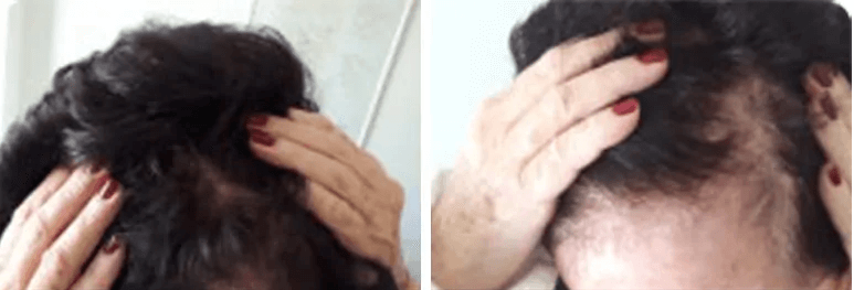 תמונת הדגמה לנשירת שיער אצל נשים