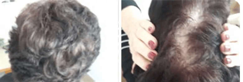 תמונות דוגמא לנשירת שיער אצל נשים 