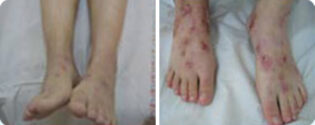 אסטמה של העור ברגליים - לפני ואחרי