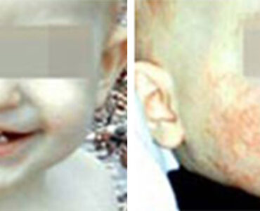 אסטמה של העור תינוקות