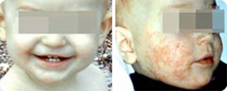 אסטמה של העור תינוקות