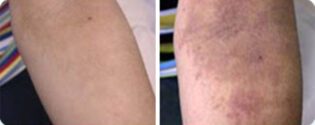 אסטמה של העור - לפני ואחרי