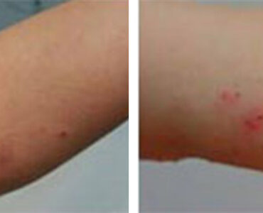 אסטמה של העור ביד - לפני ואחרי