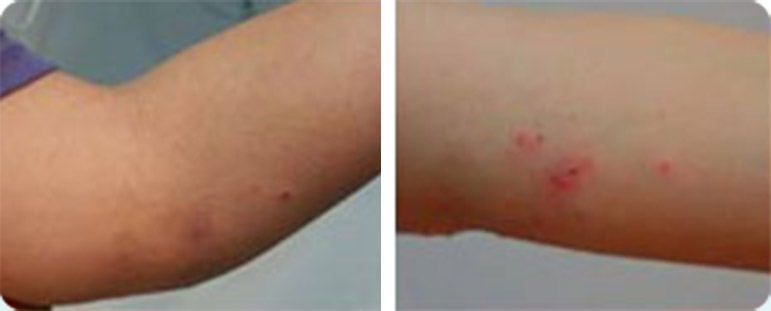 אסטמה של העור ביד - לפני ואחרי
