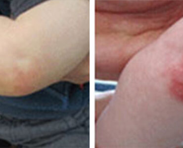 אסטמה של העור תינוקות - לפני ואחרי