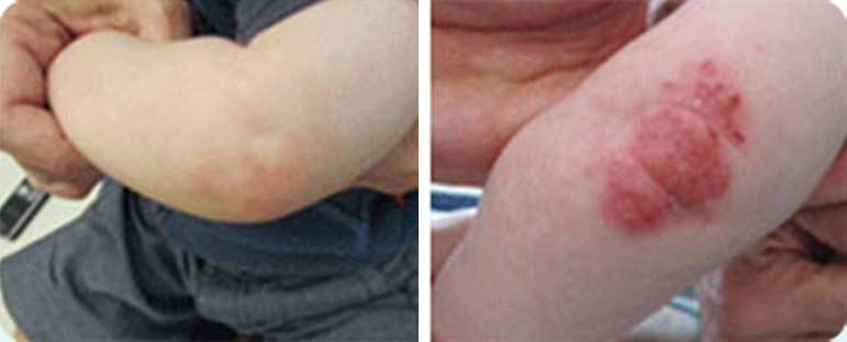 אסטמה של העור מרפק של תינוק - לפני ואחרי