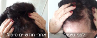 נשירת שיער נשים - לפני ואחרי