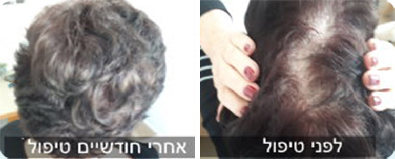 נשירת שיער נשים - לפני ואחרי טיפול