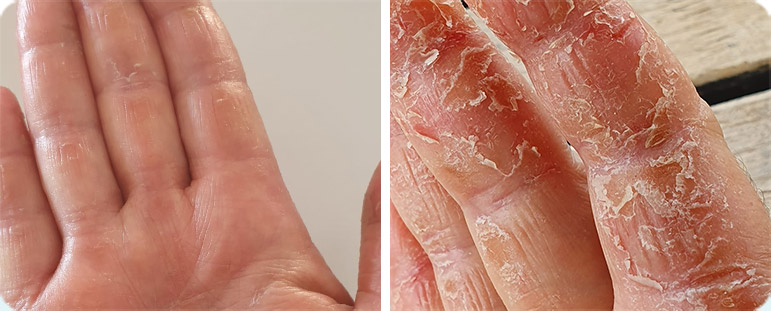 פסוריאזיס בידיים - לפני ואחרי טיפול