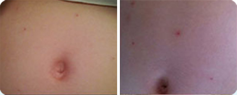 מולוסקום בבטן - לפני ואחרי