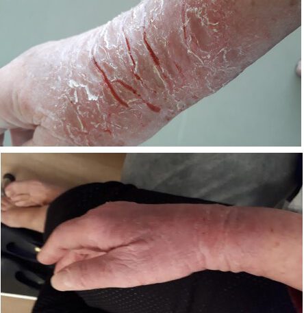 אסטמה של העור ביד - לפני ואחרי