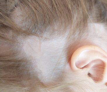 אלופציה אראטה אצל ילדה