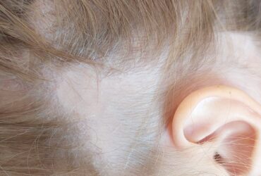 אלופציה אראטה אצל ילדה