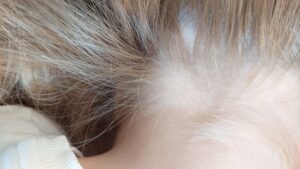 אלופציה אראטה אצל ילדה