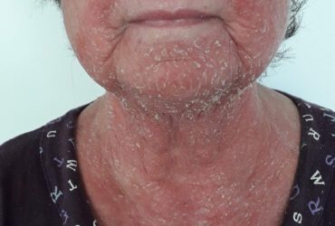 אסטמה של העור אצל מבוגרים
