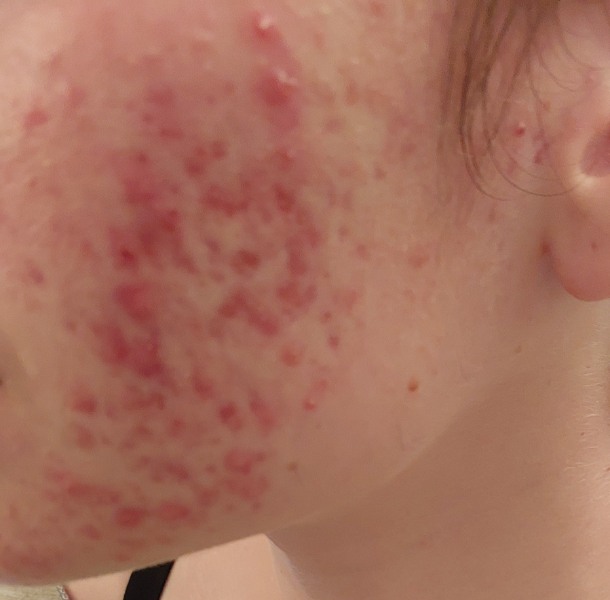 אקנה בפנים - על הלחי