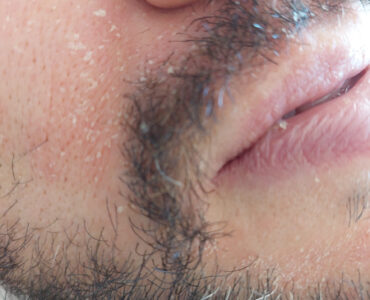 סבוריאה בפנים - באיזור הפה - אריק