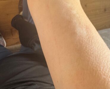 ויטילגו ביד אחרי