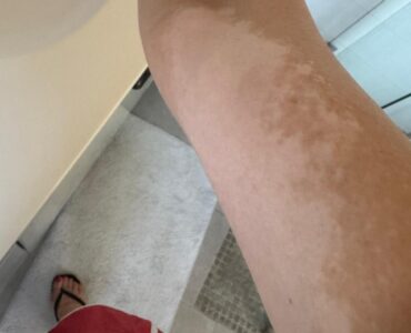 ויטילגו ביד לפני