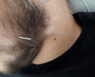 ויטיליגו בזקן ובצוואר