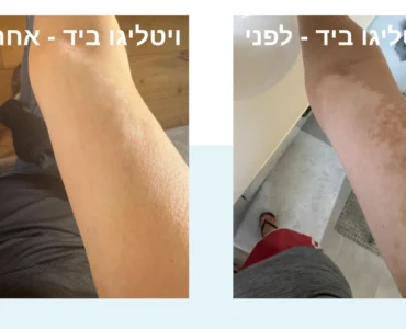 ויטליגו ביד