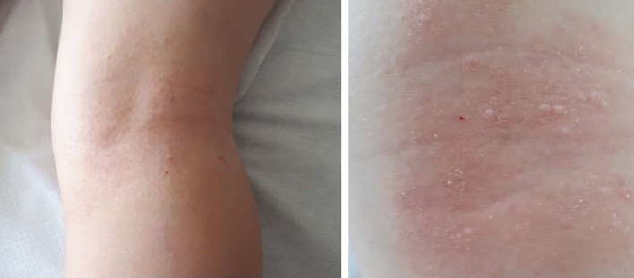 מולוסקום - לפני ואחרי חודשיים של טיפול בדיקור