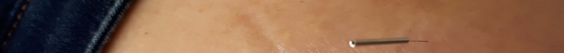 מורפיאה - סקלרודרמה מוגבלת