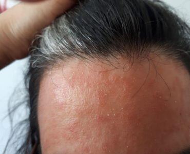 סבוריאה במצח לפני טיפול