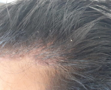 סבוריאה בקרקפת