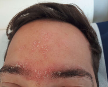 סבוריאה דרמטיטיס