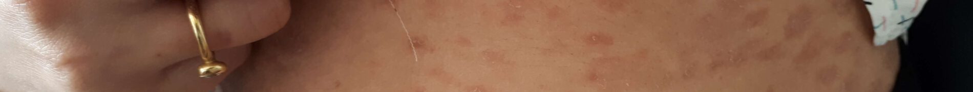 פיטריאזיס רוזיאה