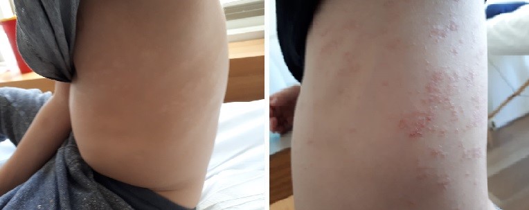 לפני ואחרי חודש טיפול בפסוריאזיס אצל ילד בן 5