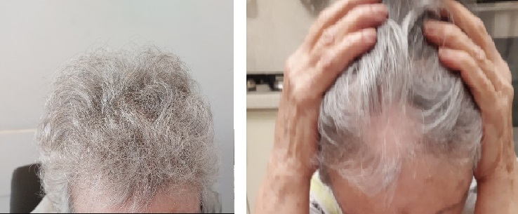 טיפול בנשירת שיער אצל נשים