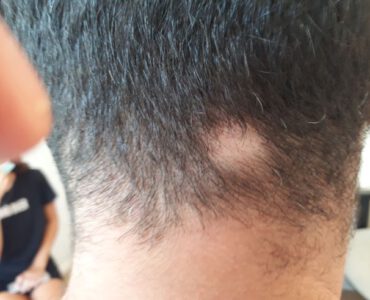 אלופציה כעיגול של נשירת שיער ממוקדת - דוד פרלה