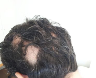 אלופציה במספר מוקדים של איבוד שיער