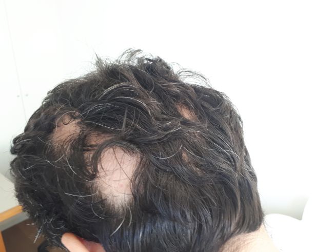 אלופציה במספר מוקדים של איבוד שיער