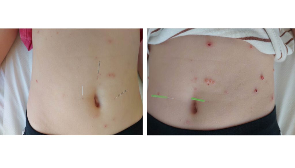  טיפול בדיקור במולסקום בבטן לפני ואחרי