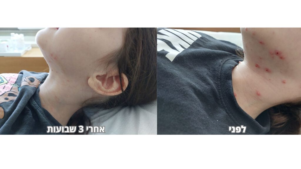 מולוסקום בפנים - לפני ואחרי טיפול