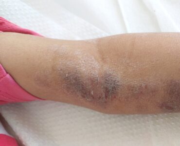 אטופיק דרמטיטיס ילדה בת חמש