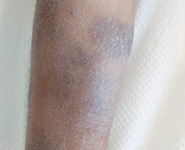 אטופיק דרמטיטיס ילדה בת חמש