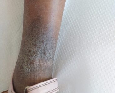 אטופיק דרמטיטיס ילדה בת חמש