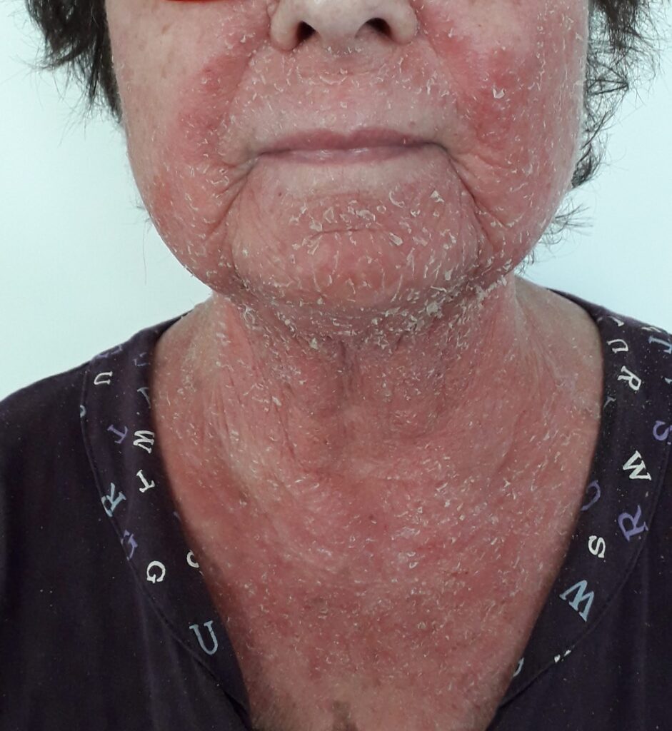 אטופיק חמור בפנים לפני טיפול