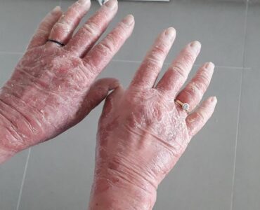 אטופיק ידיים לפני טיפול