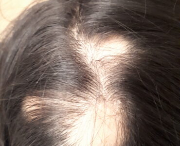 אלופציה אראטה בקרקפת