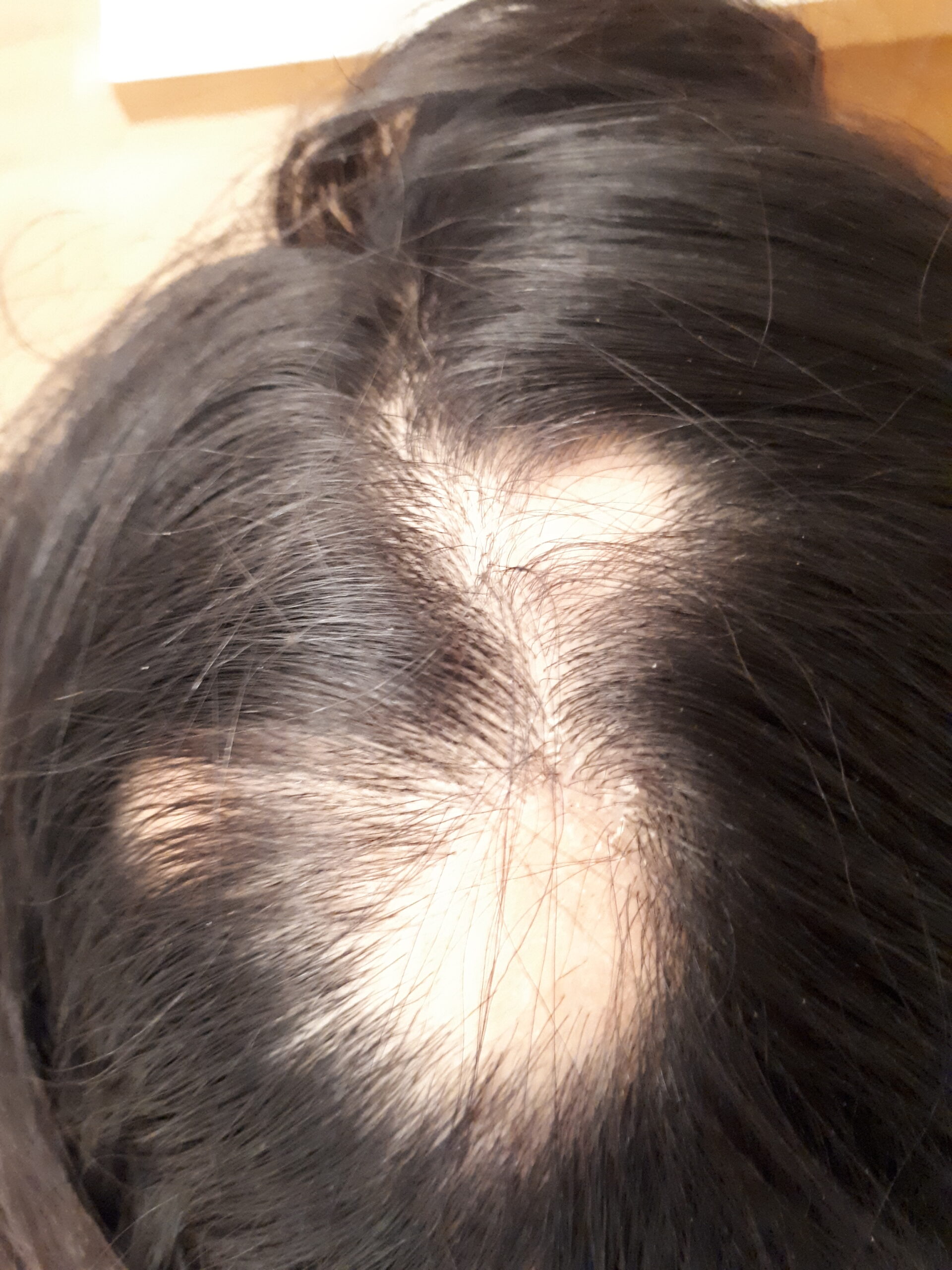 אלופציה אראטה בקרקפת