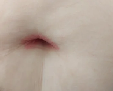 פסוריאזיס אינברסה הפוכה בטאבור